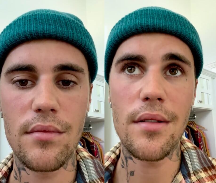Justin Bieber sufre parálisis facial