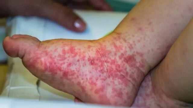 ¿Qué es la gripe del tomate, una enfermedad contagiosa y rara que afecta a niños y niñas?