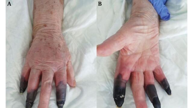 Coronavirus le provoca gangrena
