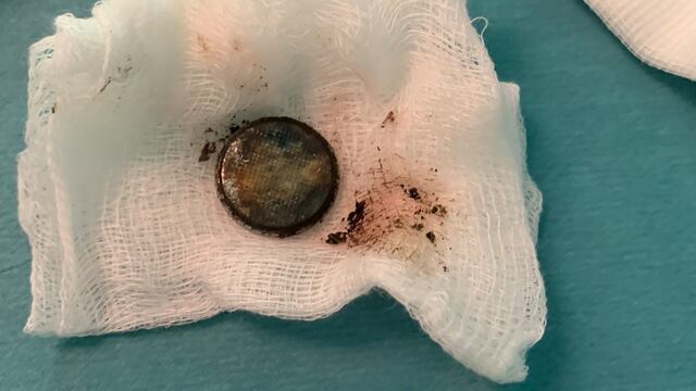 Pila de botón que fue tragada por una niña