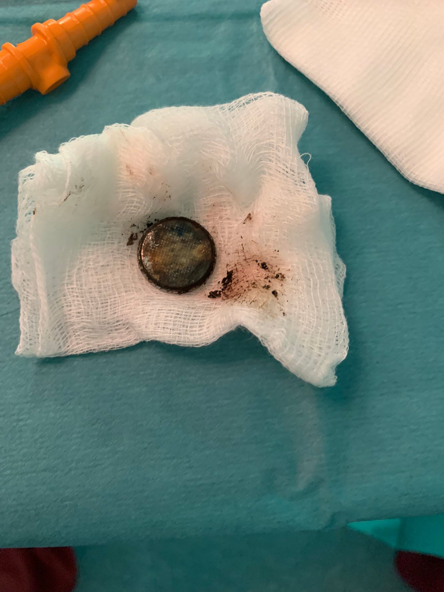 Pila de botón que fue tragada por una niña