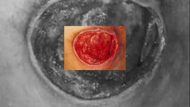 Qué son las úlceras por decúbito