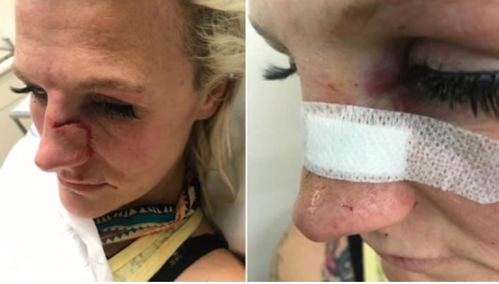 Cindy Dandois muestra sus golpes