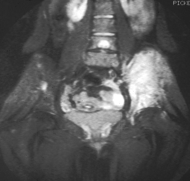 Sarcoma de Erwig