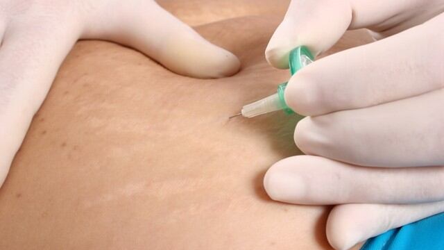 Subir de peso y de masa muscular de manera acelerada provocan estrías en la piel.