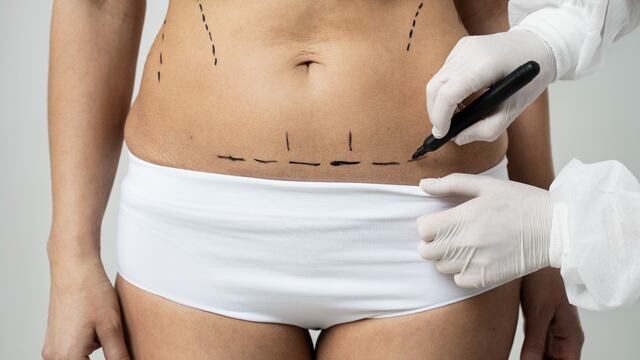 Liposucción de alta definición