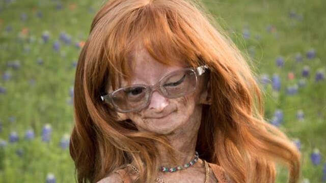 Muere Adalia Rose Williams, superestrella de YouTube popular por su síndrome de envejecimiento
