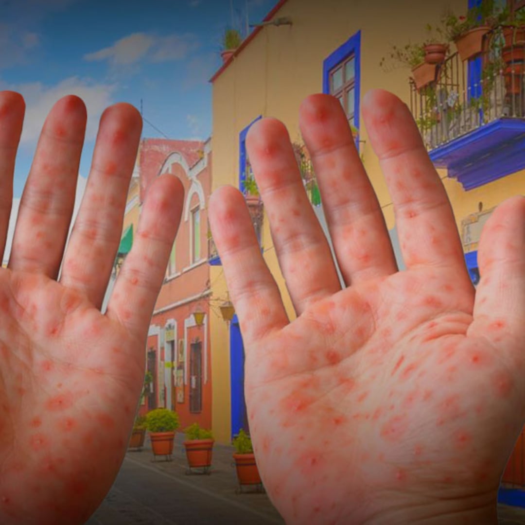 La cuarta transformación fue real… regresó el sarampión