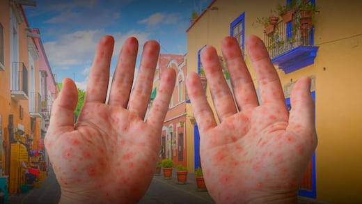Sarampión en Puebla: 16 nuevos contagios y municipios más afectados