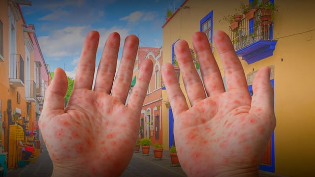Sarampión en Puebla: 16 nuevos contagios y municipios más afectados