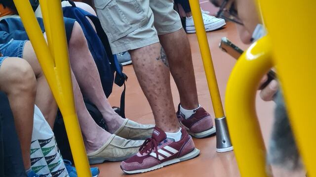 Hombre con viruela del mono