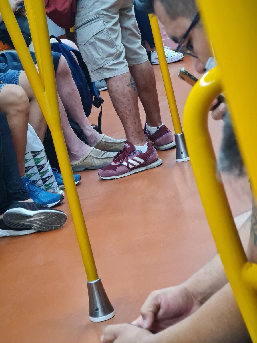 Hombre con viruela del mono