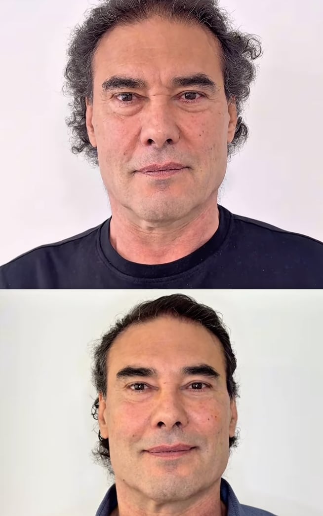 Eduardo Yáñez se somete a tratamiento facial y así luce ahora
