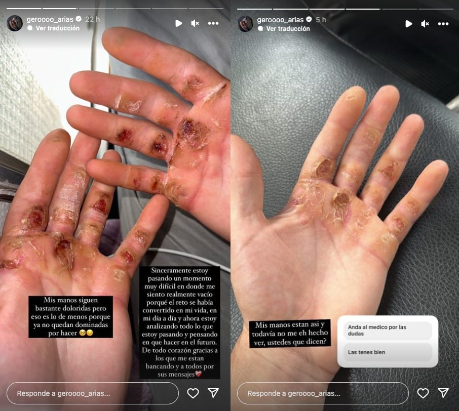 Manos de Gero Arias tras reto de dominadas