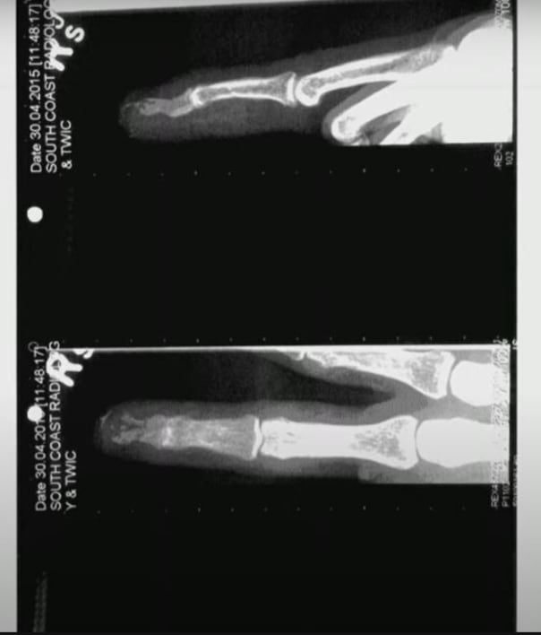 Radiografía del dedo de Johnny Depp