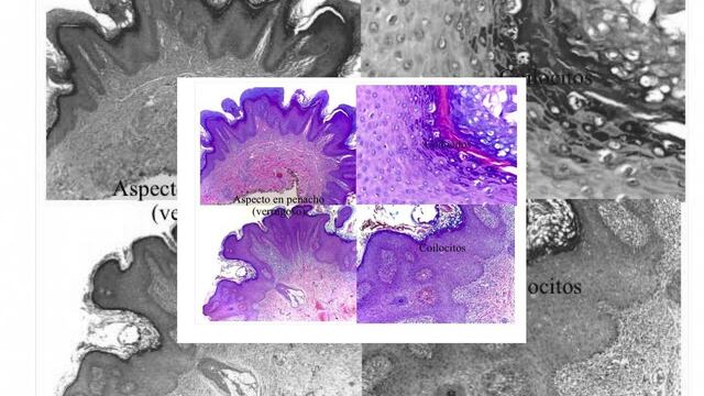 ¡Caras vemos, papilomas desconocemos! Una enfermedad que el Dr. Google no cura