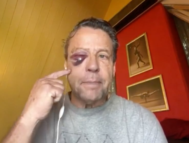 Alfredo Adame muestra dónde tiene las fracturas de su cara.