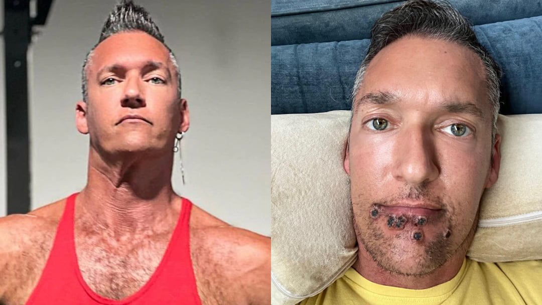 Actor porno con Viruela del Mono