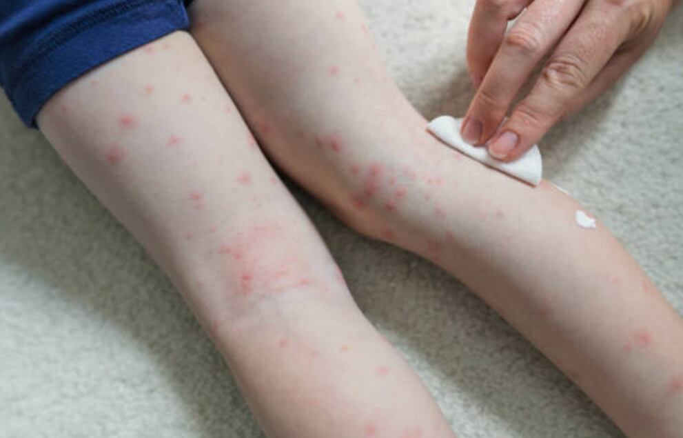 Gripe del tomate: qué es, síntomas y cómo se contagia