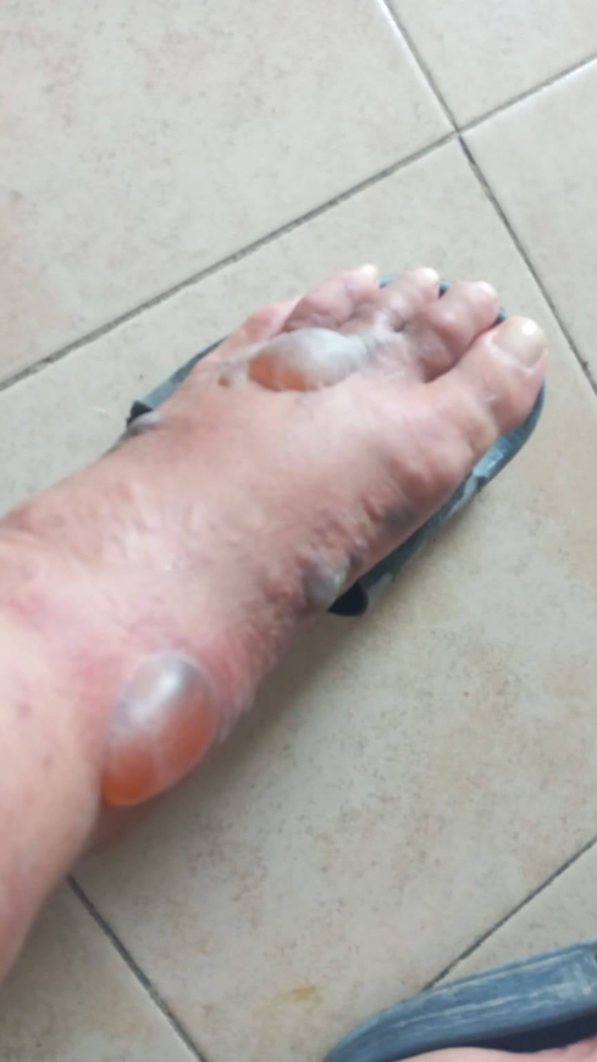 Gerardo Martínez Bautista fue mordido por una araña violinista