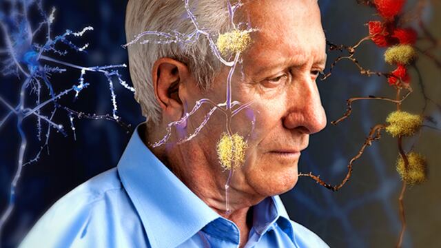 La enfermedad de Alzheimer se relaciona de manera importante con la edad y factores genéticos