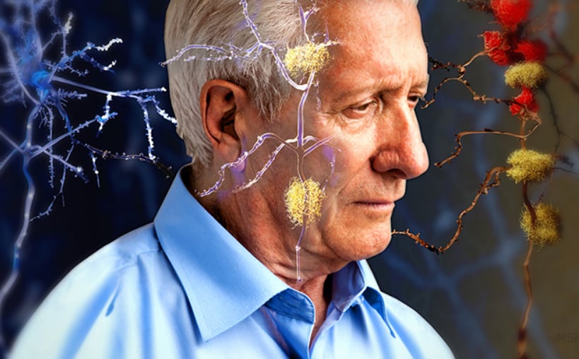 Alzheimer