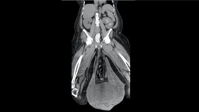Escroto crecido linfedema