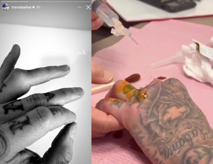 Travis Barker comparte alarmantes fotografías