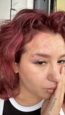 Romina Marcos tiene herpes zoster