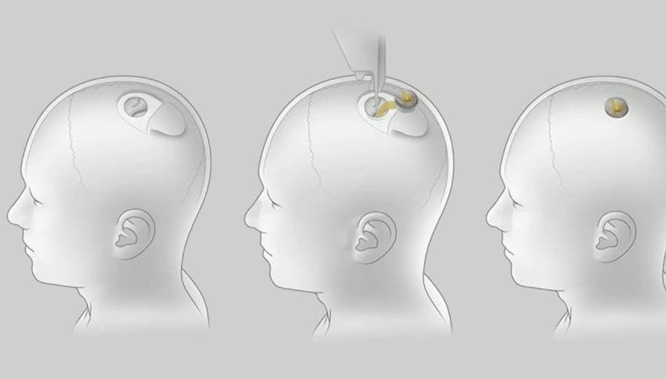Elon Musk y Neuralink preparan ensayos para implantar microchips cerebrales en humanos