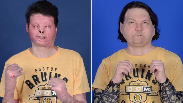 Trasplante de rostro y manos de Joe DiMeo