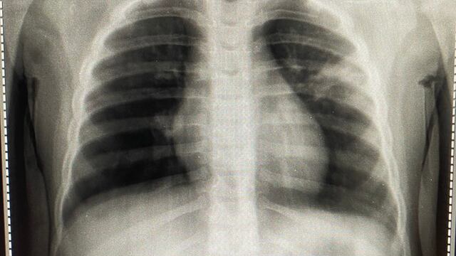 Radiografía pulmones