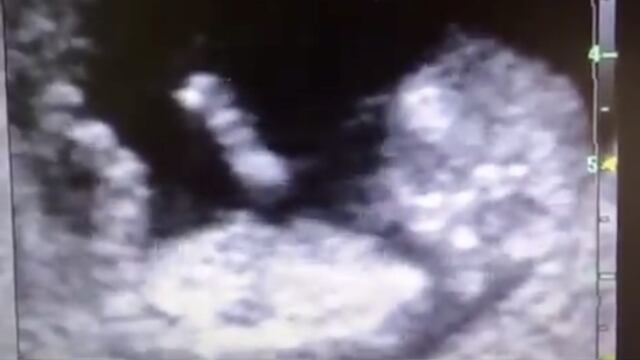 Captan a feto mientras juega en el vientre de su madre.