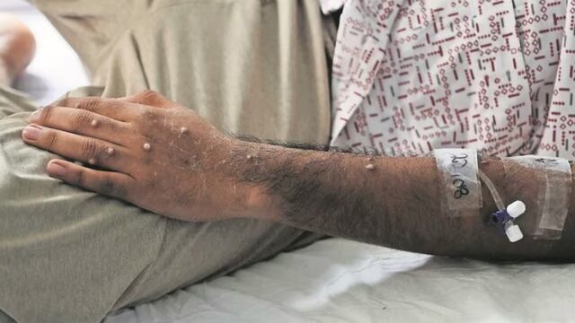 Viruela del mono OMS: Se analiza reunión urgente por esta razón