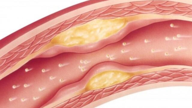 Grasa en las arterias beneficios