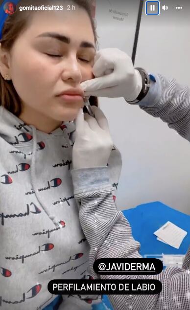 Realizan a Gomita perfilamiento de labios