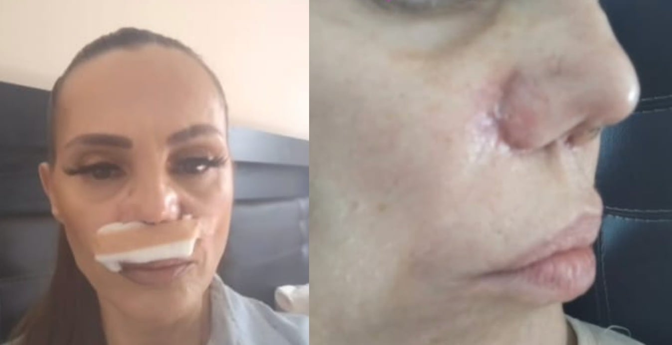 Carmen Campuzano muestra los resultados de su nueva cirugía de nariz