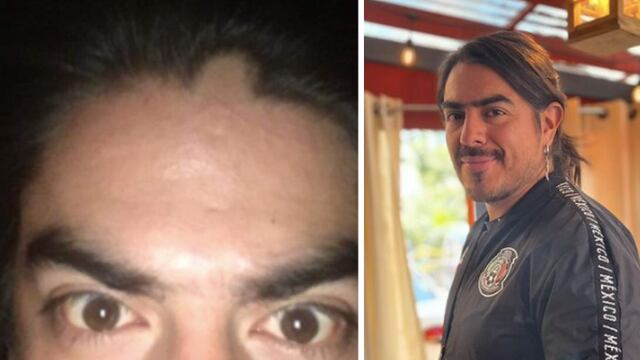 Rey Grupero padece alopecia