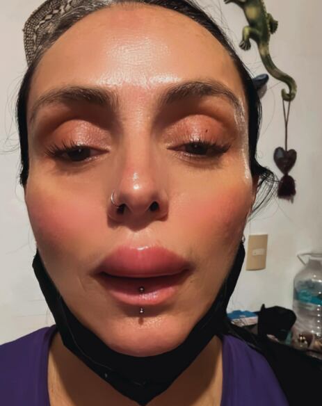 Ivonne Montero y su labio hinchado preocupa a sus fans, esto fue lo que le pasó
