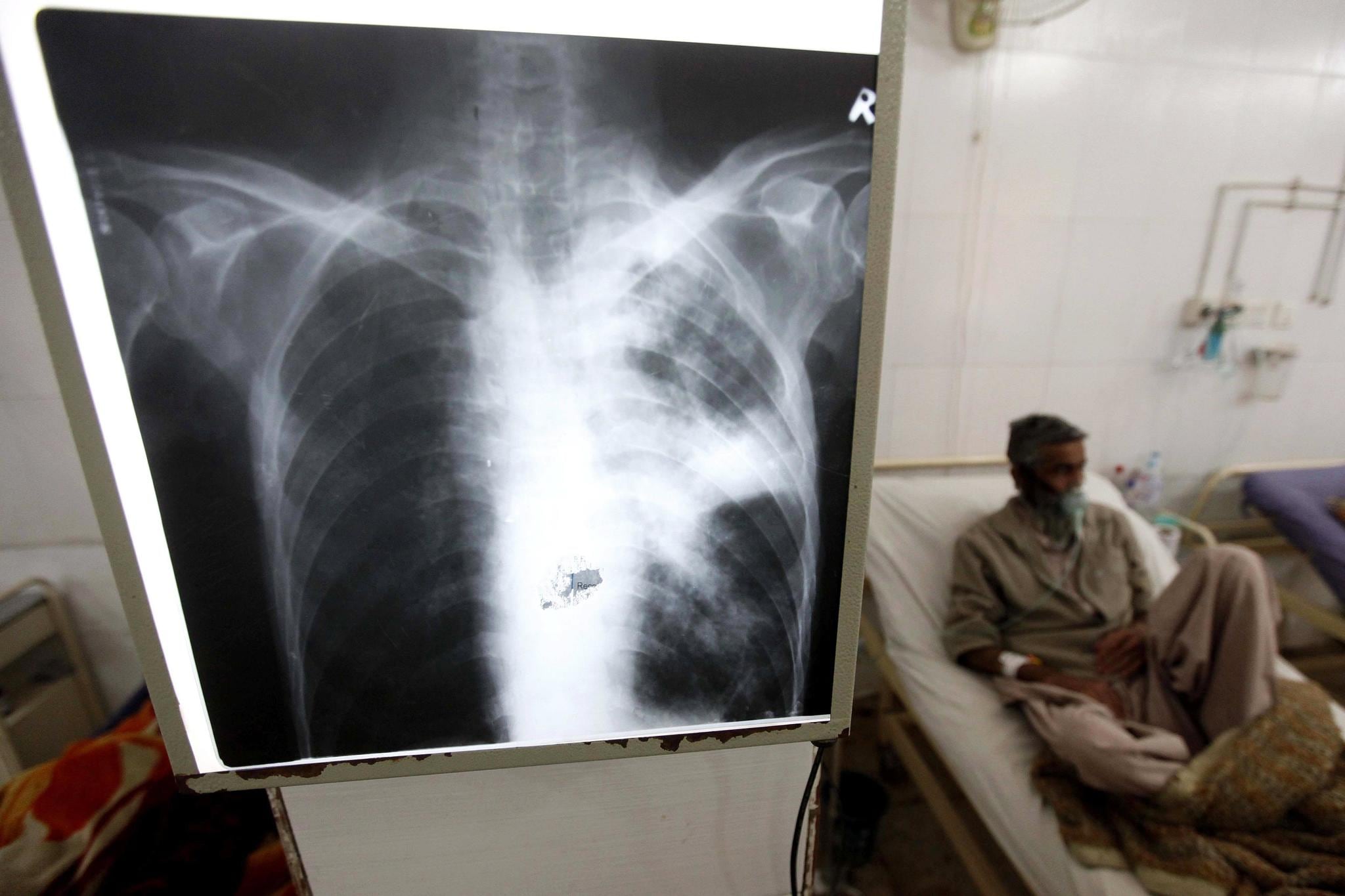 Paciente con tuberculosis