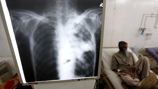 Paciente con tuberculosis