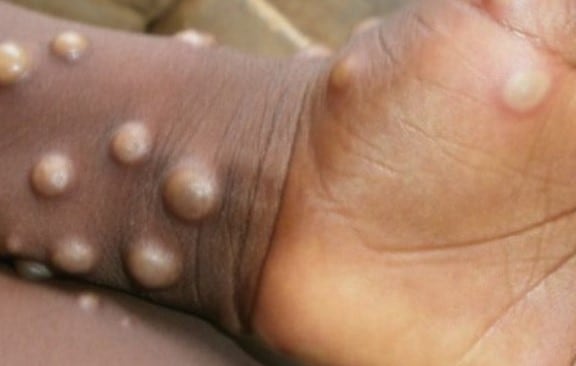 ¿Virus Mpox es la nueva emergencia sanitaria global? OMS tomará pronto una decisión