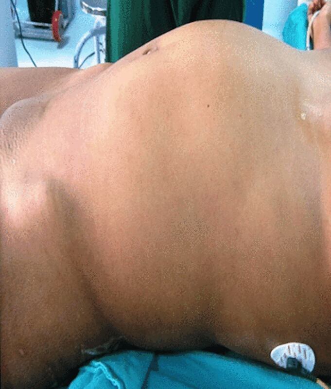 Así lucía el abdomen de la joven india con el feto de su gemelo