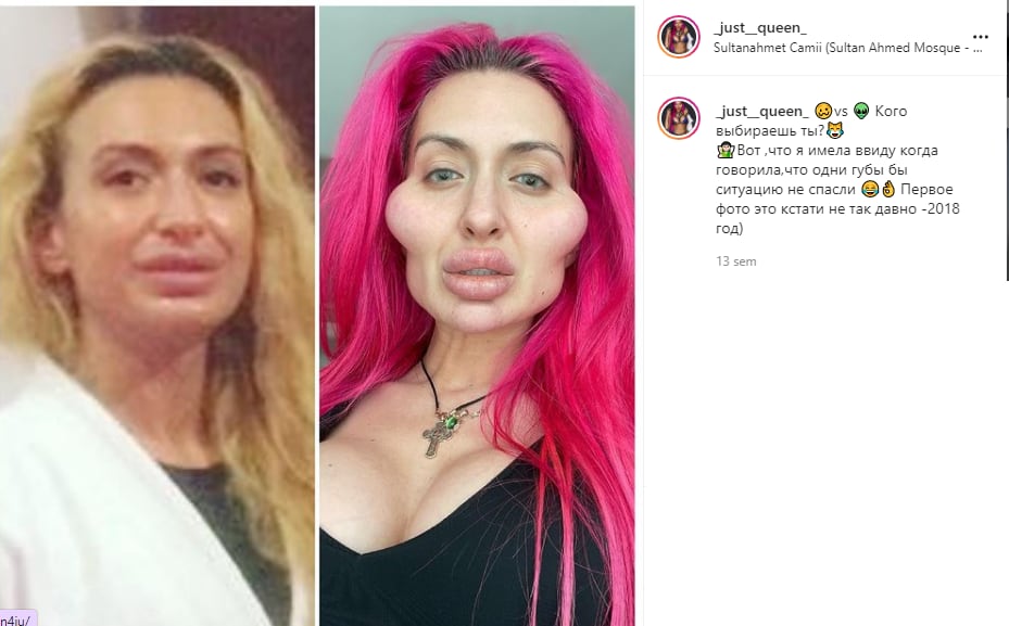 Instagram; Anastasia Pokreshchuk muestra su antes y después.