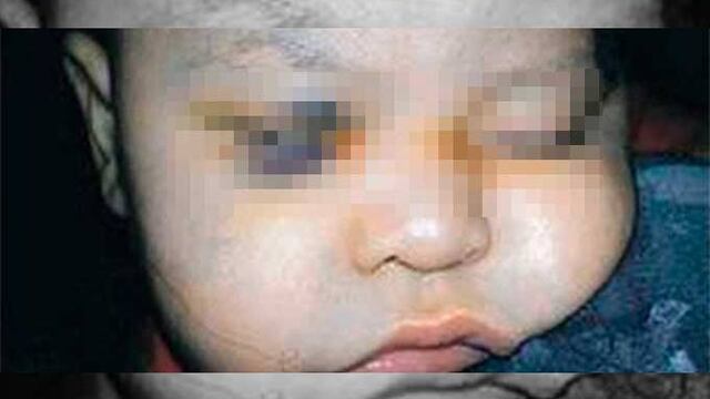 Abre CEDH expediente de queja por cirugía de ojo a menor en Sonora