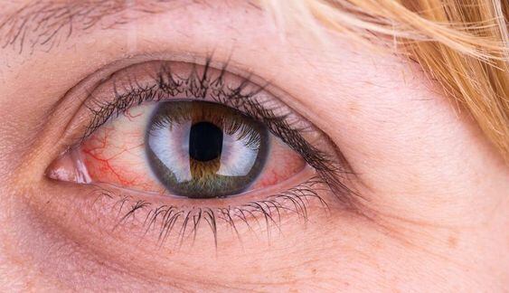 Conjuntivitis por Covid-19