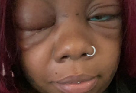 Mujer con problema en ambos ojos