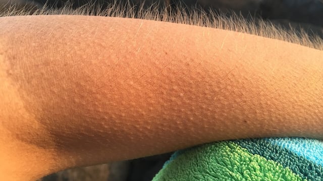 "Piel chinita"